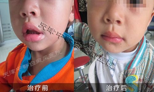 小孩嘴角白斑治疗前后对比图