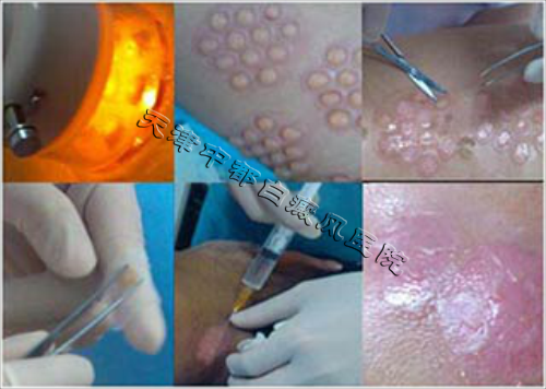 皮肤表皮自体移植术过程